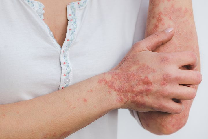You are currently viewing 3 conseils pour soigner l’eczema